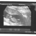 3. ultrazvok -11 tedn-nuhalna