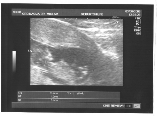 3. ultrazvok -11 tedn-nuhalna