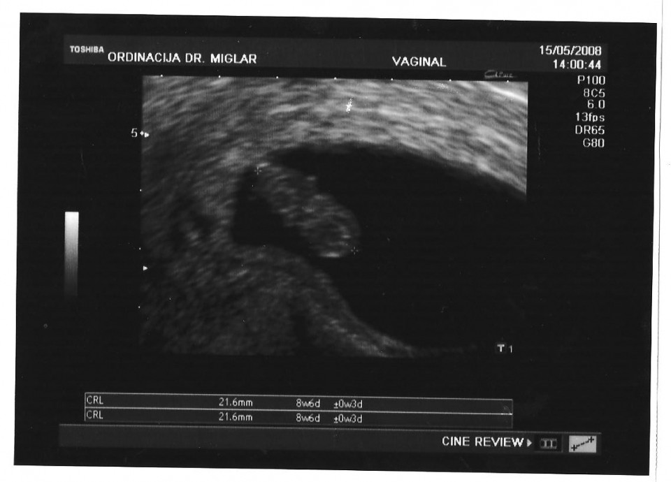 1. ultrazvok-9 tedn